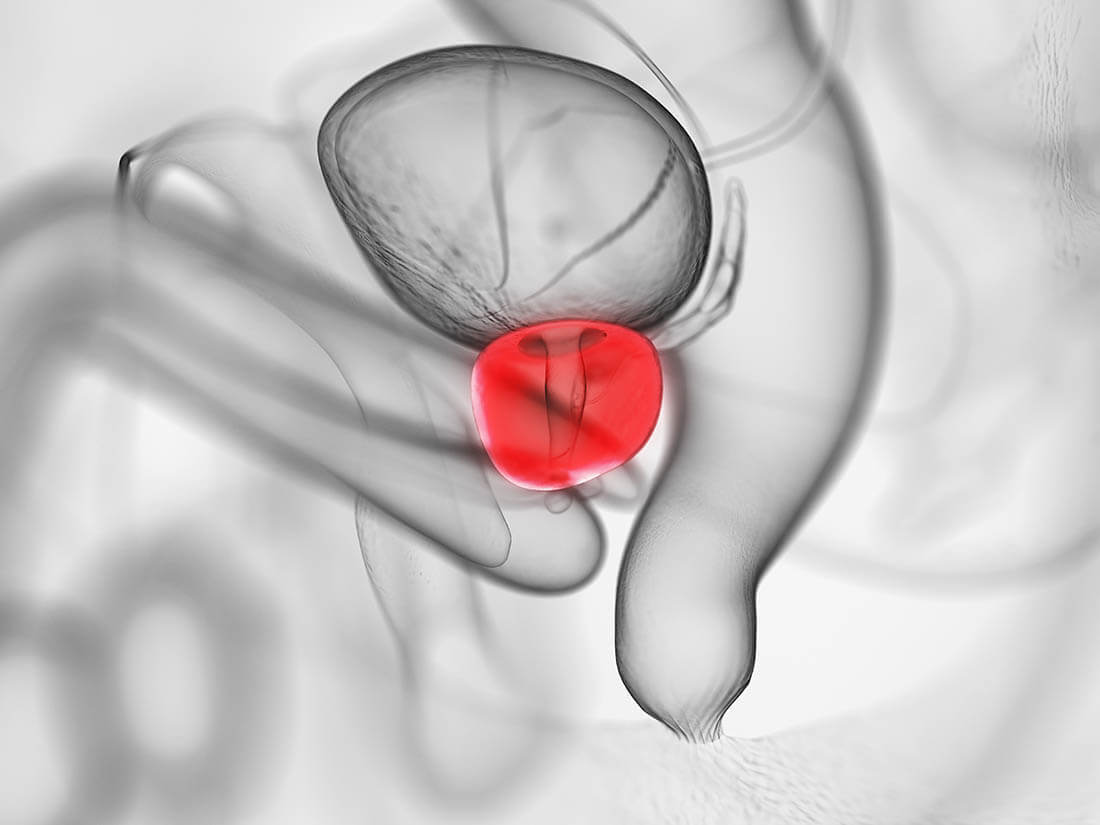 Qué antiinflamatorio es bueno para la prostatitis