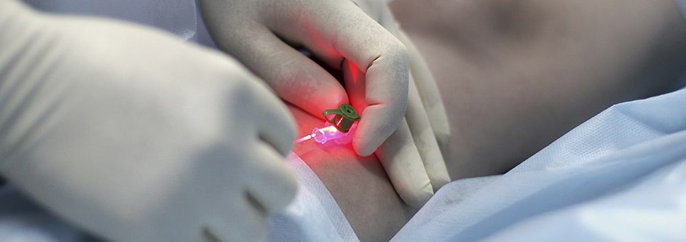 Лазерное лечение ног в казани